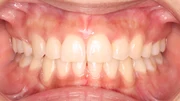 難しいケース1.叢生の治療後
