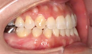 難しいケース3.下顎前突の治療後