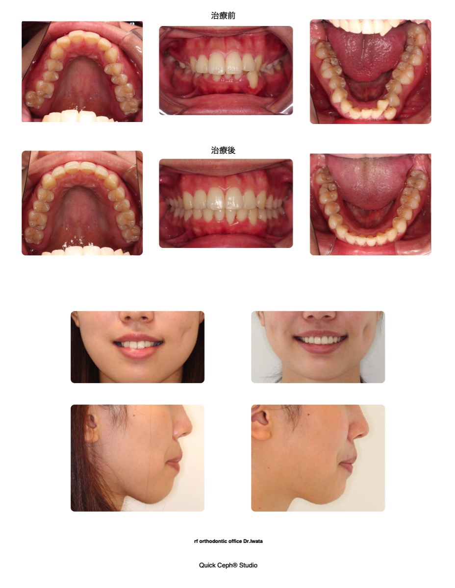 叢生および鋏状咬合を伴う過蓋咬合に対する非抜歯矯正治療 福岡天神矯正歯科