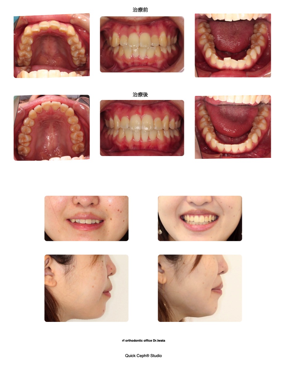 上下顎前歯部叢生に対する非抜歯矯正治療 | 福岡天神矯正歯科