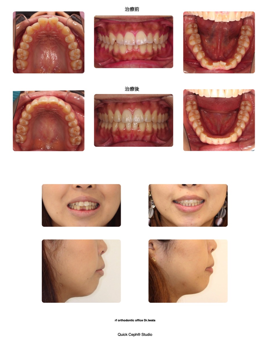 前歯部叢生を伴う上顎前突（出っ歯）に対する非抜歯矯正治療 | 福岡
