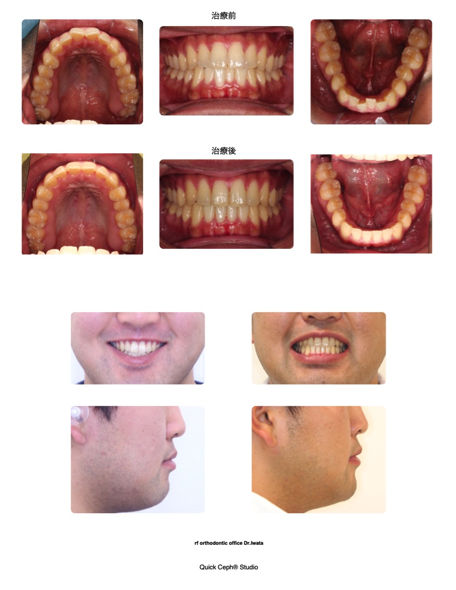 上下顎前歯部叢生に対する非抜歯矯正治療 | 福岡天神矯正歯科