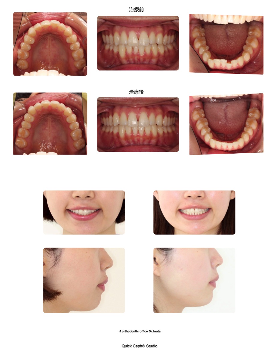 非抜歯矯正治療 : Molar Oriented Orthodonticsの実際