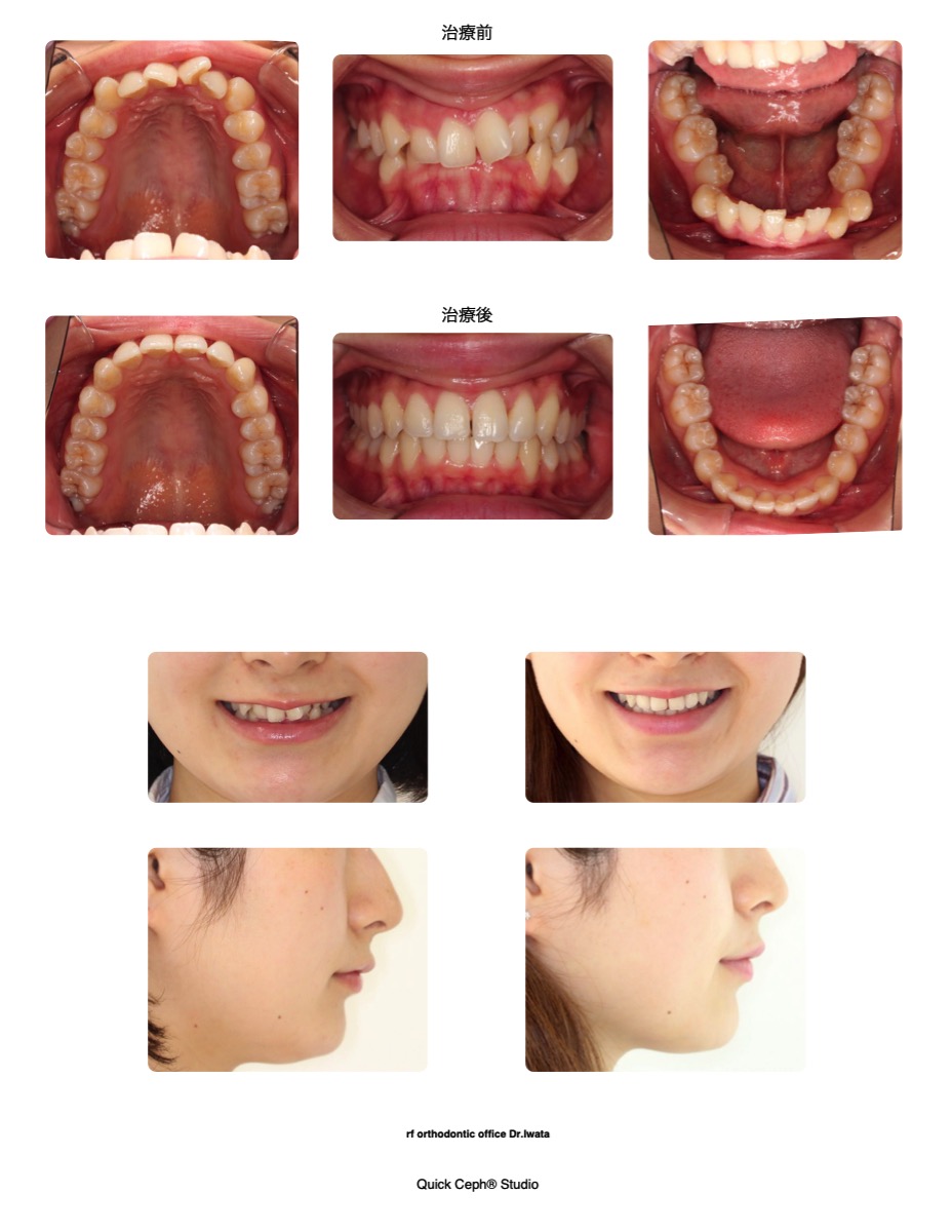 196 非抜歯矯正 重度叢生を併う過蓋咬合に対する非抜歯矯正治療 | 福岡天神矯正歯科