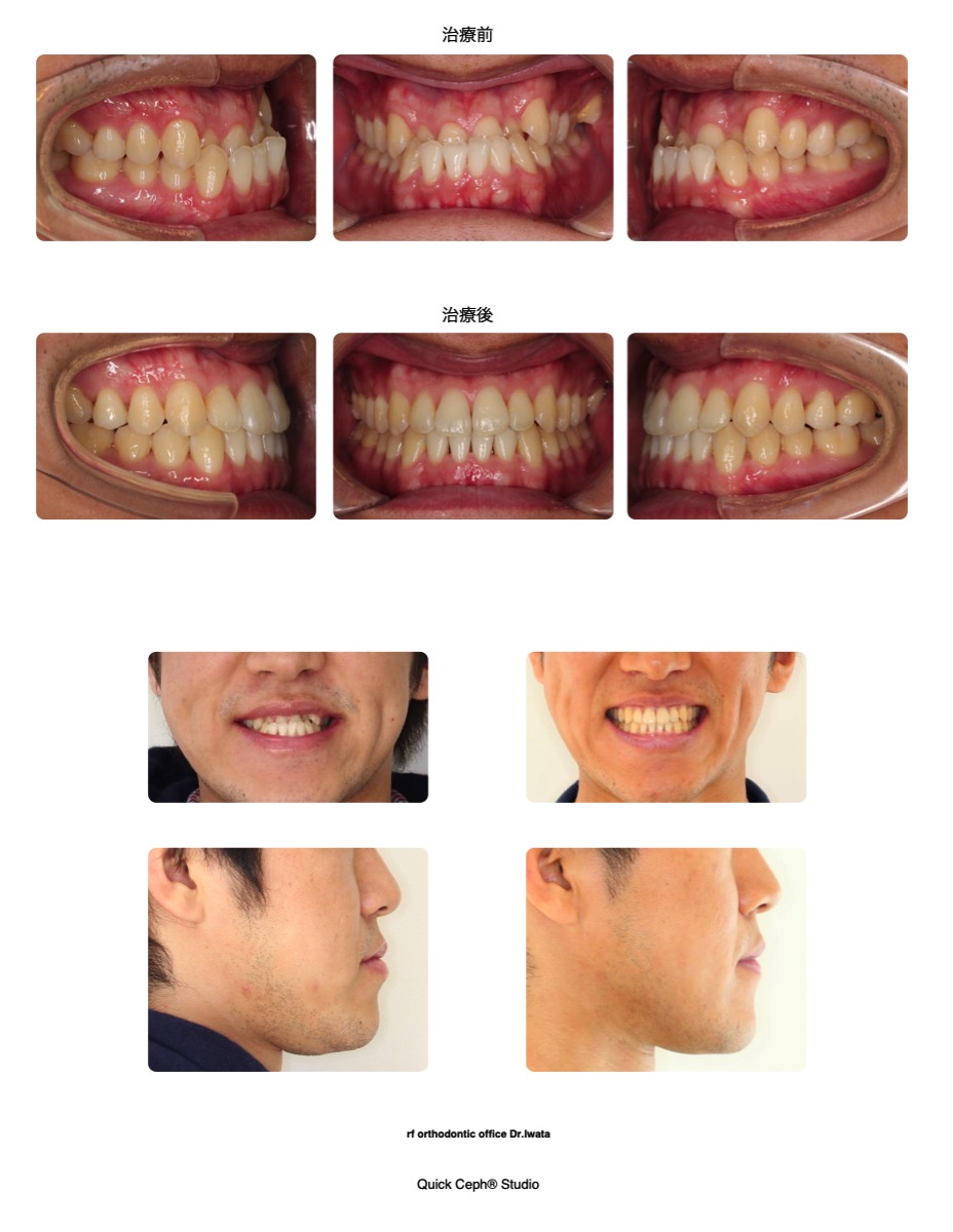 下顎前突 受け口 で遠方からの通院患者へインビザラインにて対応を行った非抜歯矯正治療 福岡天神矯正歯科