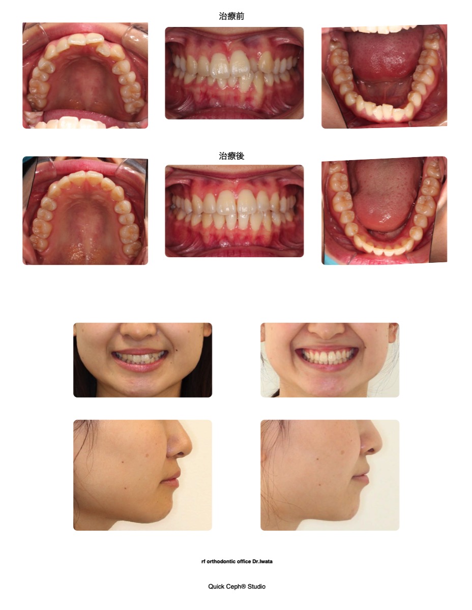 重度の上下顎前歯部叢生に対する非抜歯矯正治療 | 福岡天神矯正歯科