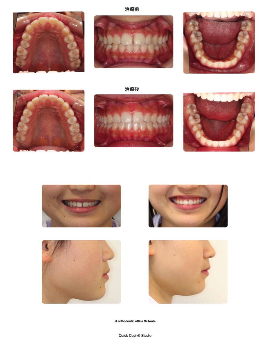 正中離開と叢生を伴う空隙歯列に対する非抜歯矯正治療 | 福岡天神矯正歯科
