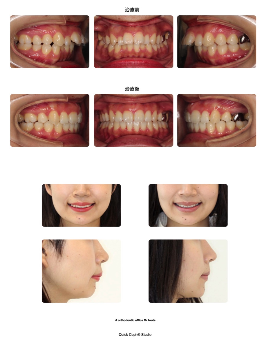 上顎のみの抜歯により出っ歯を改善した抜歯矯正治療 | 福岡天神矯正歯科