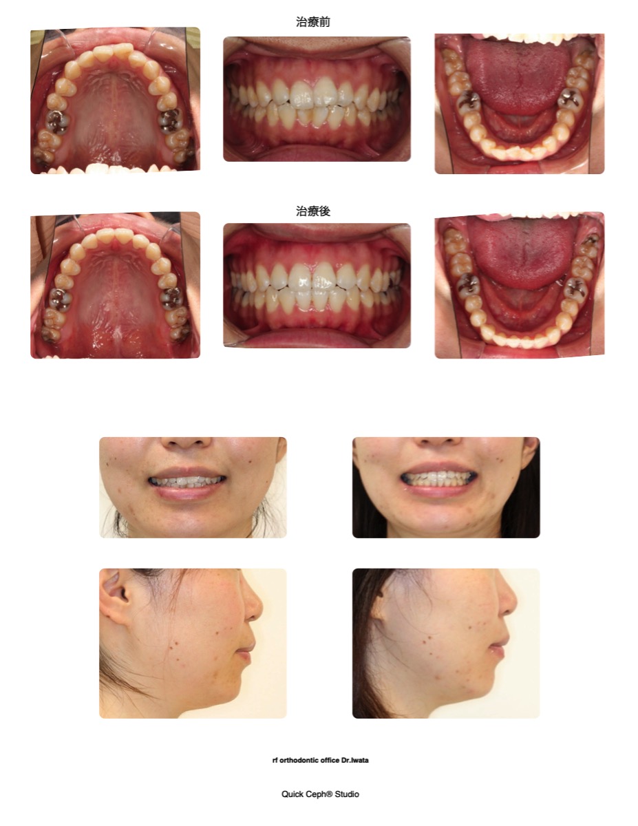 正中のズレを伴う上下顎前歯部叢生に対する非抜歯矯正治療 | 福岡