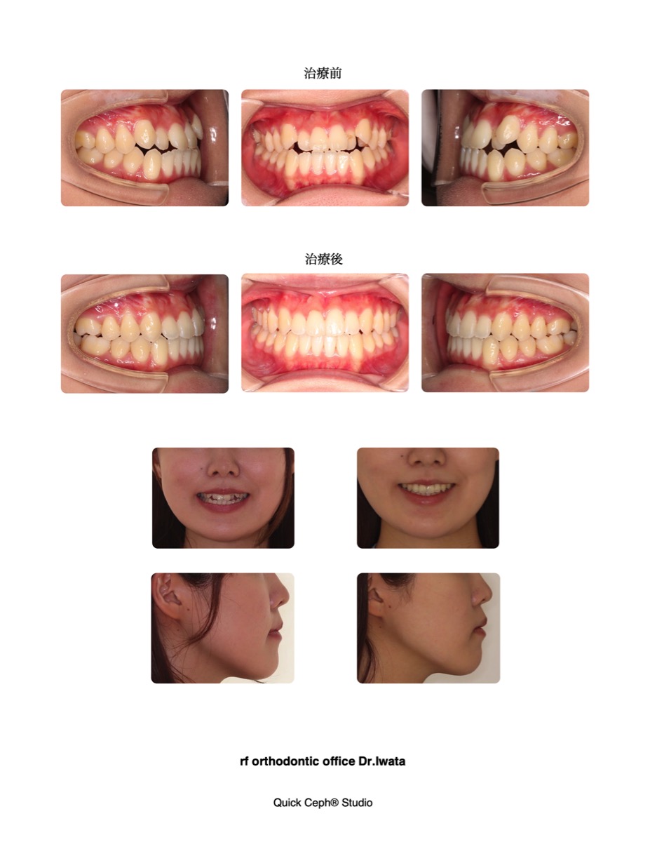 軽度骨格性非対称を伴う叢生症例に対する非抜歯矯正治療 | 福岡天神矯正歯科