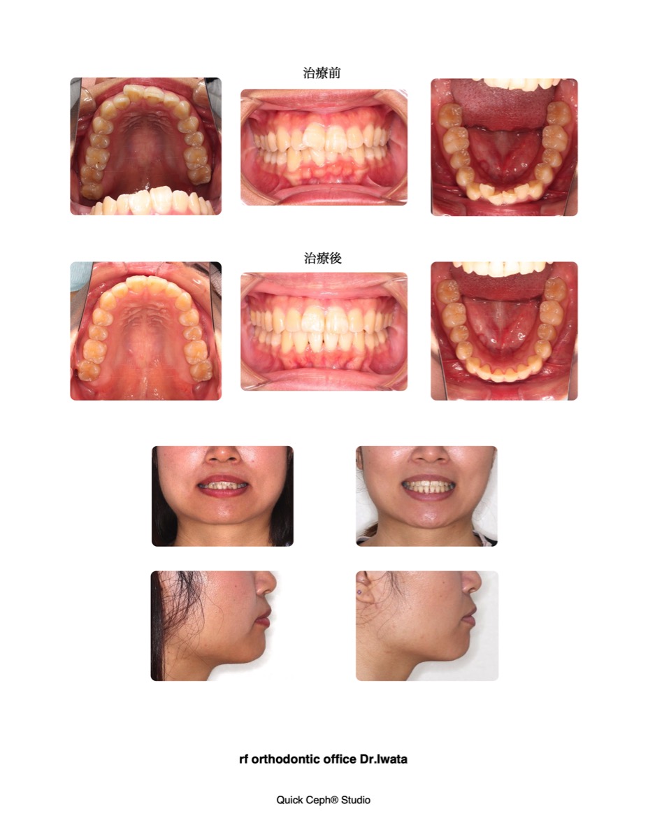 上下顎前歯部叢生に対する非抜歯矯正治療 | 福岡天神矯正歯科