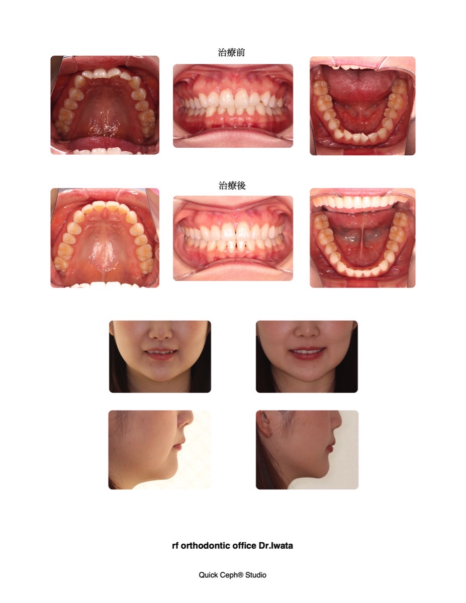 196 非抜歯矯正 叢生を伴う過蓋咬合症例に対する非抜歯矯正治療 | 福岡天神矯正歯科