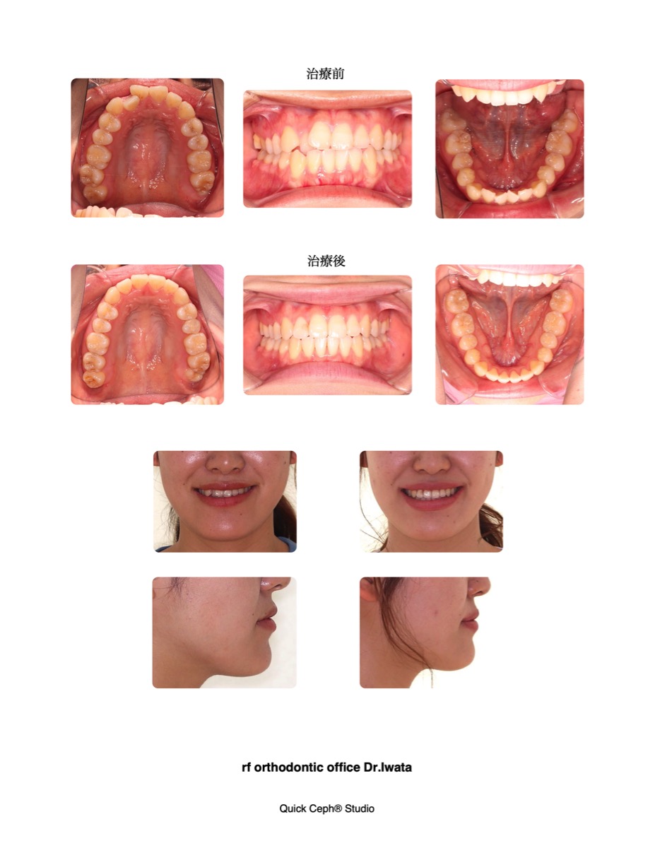 叢生を伴う下顎前突症例に対する非抜歯矯正治療 | 福岡天神矯正歯科
