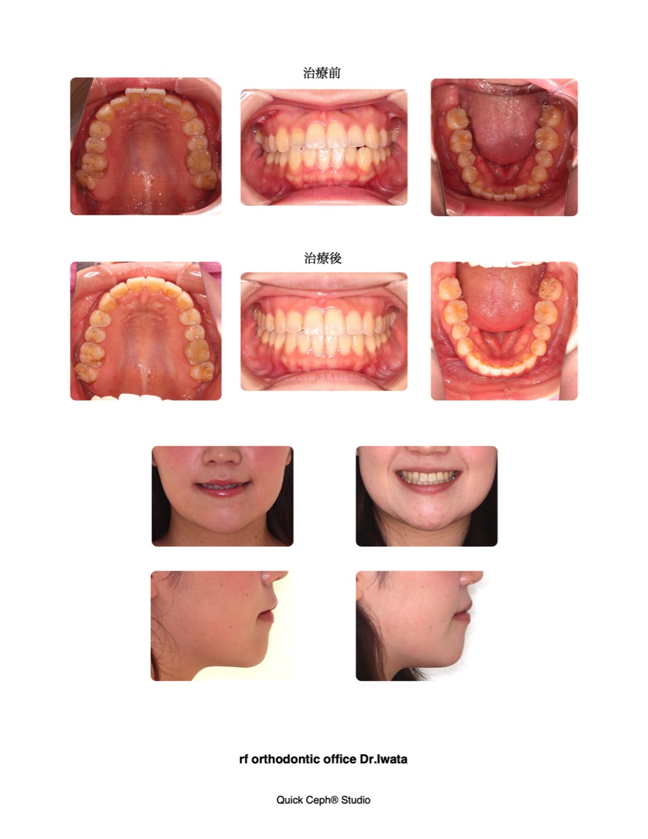 196 非抜歯矯正 非抜歯矯正