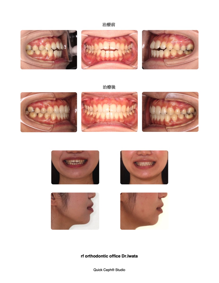 開咬症例に対する非抜歯矯正治療 | 福岡天神矯正歯科
