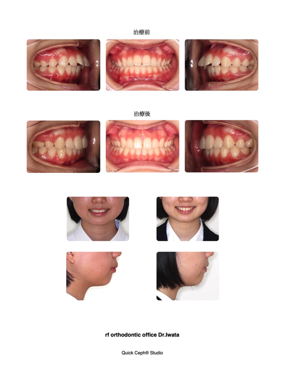 【美品】非抜歯・床矯正・Pooによる顎態調和法 非抜歯床矯正Pooによる顎態調和法￼ 非抜歯・床矯正・Poo