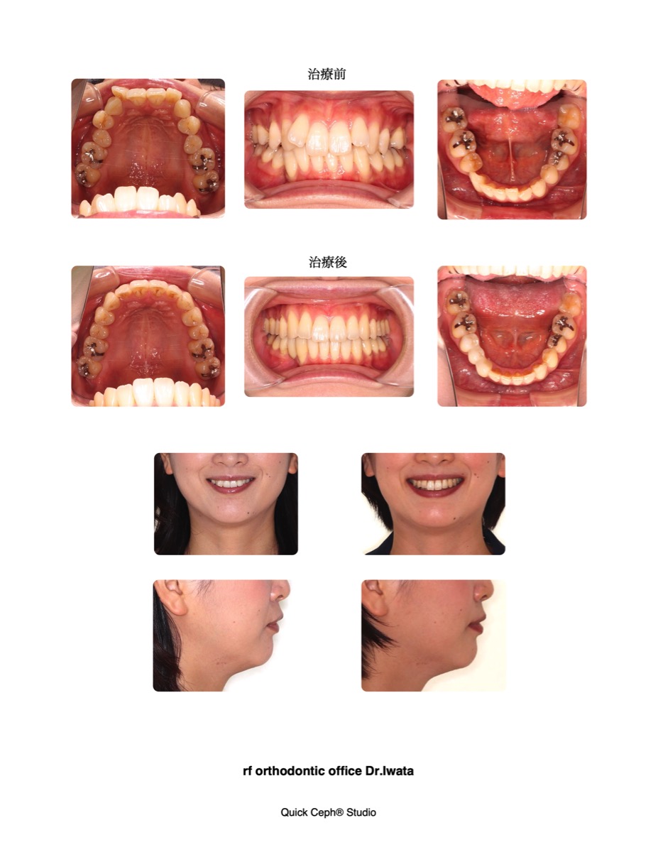 非抜歯矯正治療 : Molar Oriented Orthodonticsの実際 非抜歯矯正治療 Molar Oriented Orthodonticsの実際