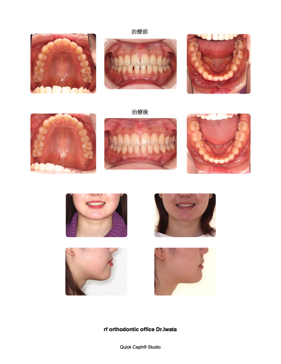 空隙歯列に対する非抜歯矯正治療 | 福岡天神矯正歯科