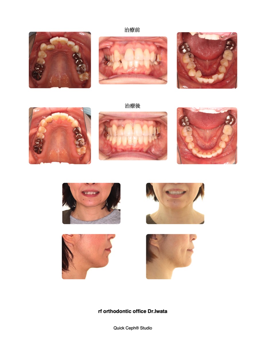 上下顎前歯部叢生に対する非抜歯矯正治療 | 福岡天神矯正歯科
