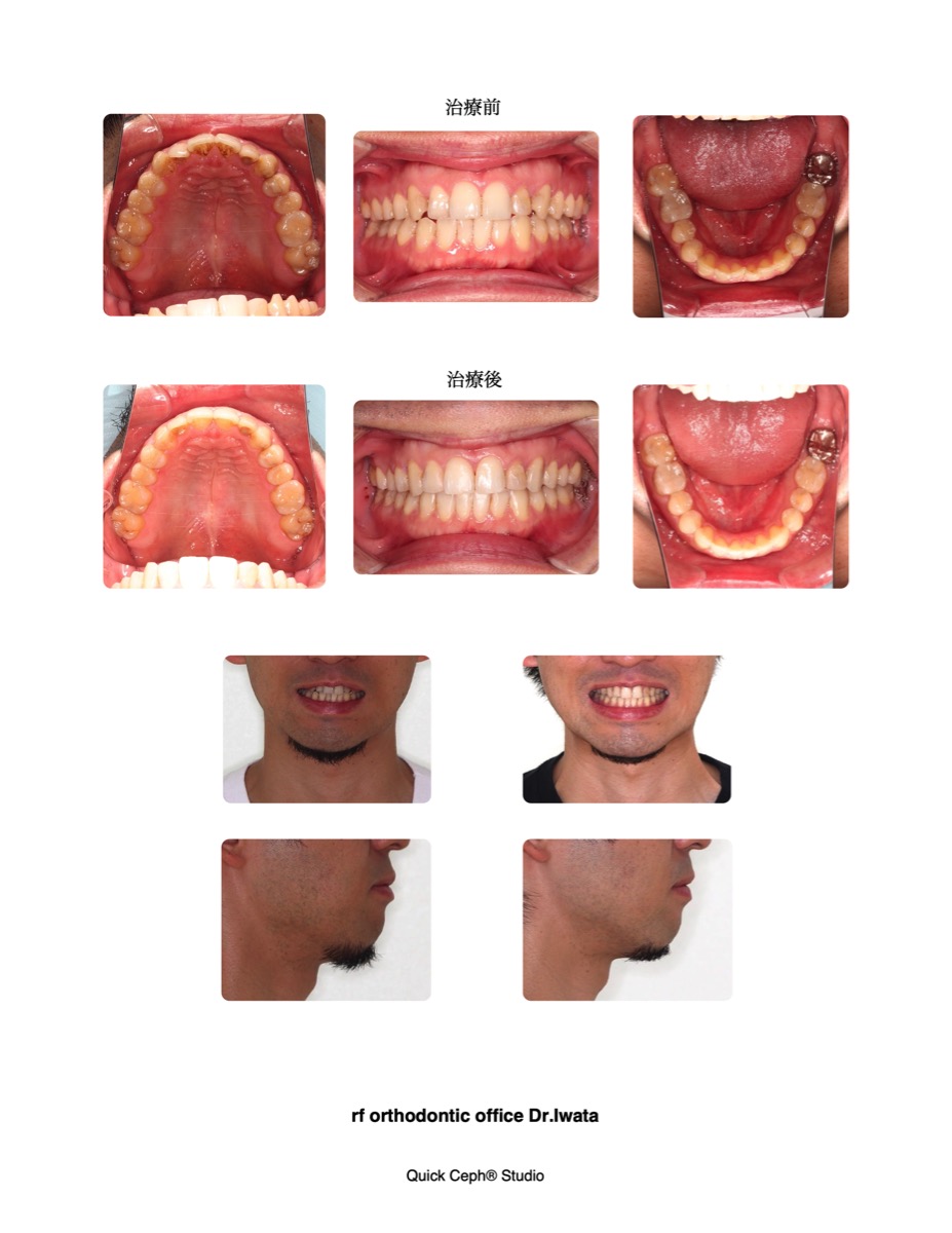 上下顎前歯部叢生に対する非抜歯矯正治療 | 福岡天神矯正歯科