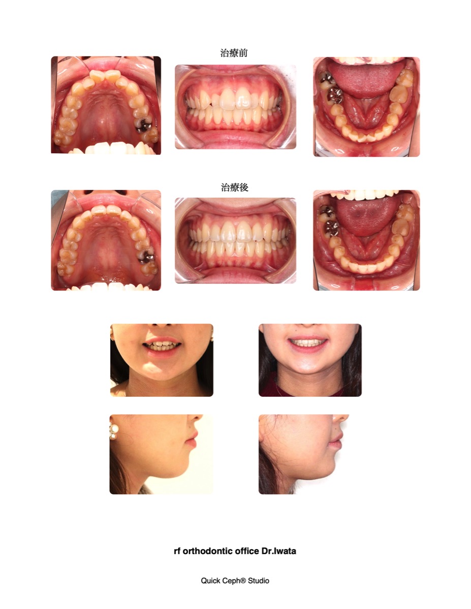 歯列狭窄を伴う叢生に対する非抜歯矯正治療 | 福岡天神矯正歯科