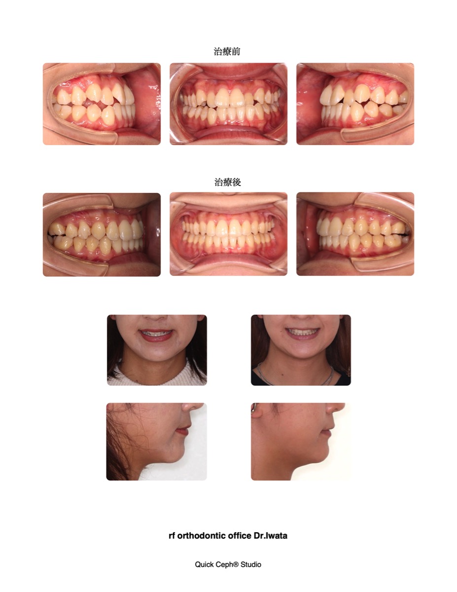 叢生を伴う反対咬合に対する非抜歯矯正治療 | 福岡天神矯正歯科
